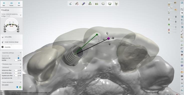 Implant restoration designed in CAD software